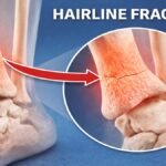 Hairline Fracture